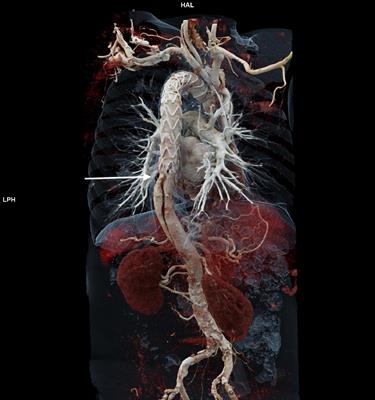 Distal Aortic Failure Following the Frozen Elephant Trunk Procedure for Aortic Dissection